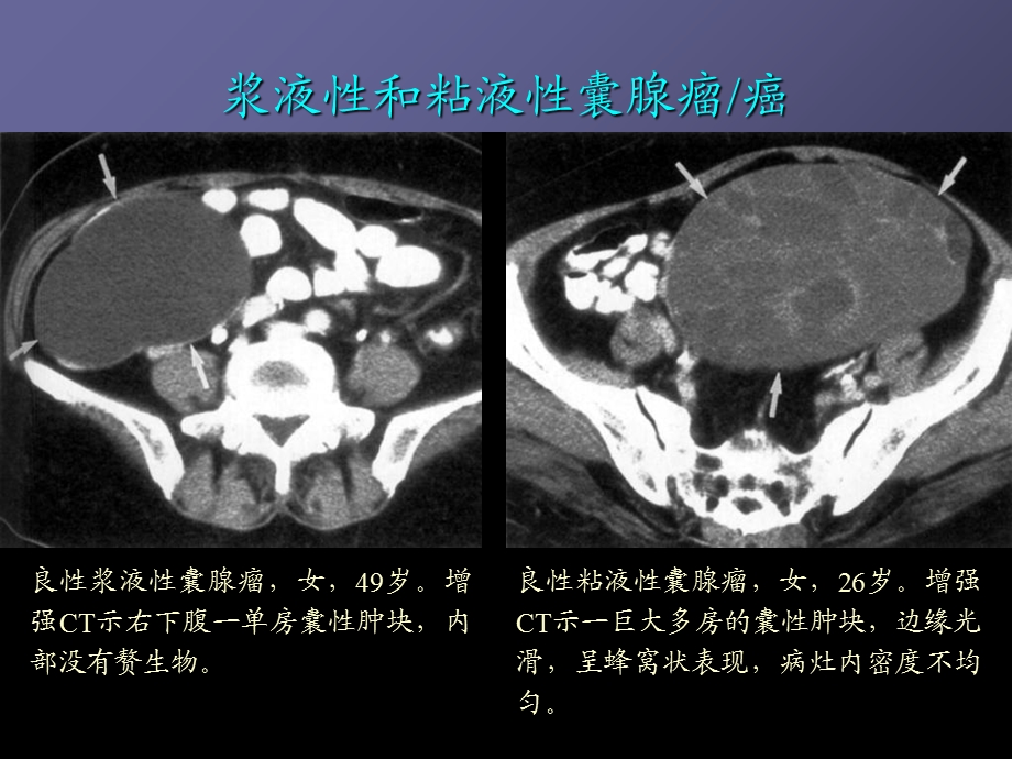 0486卵巢肿瘤的影像学表现及鉴别PPT文档.ppt_第3页