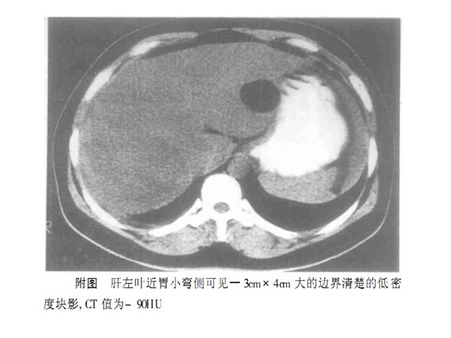 含脂肪成分的肝脏占位PPT文档.pptx_第3页