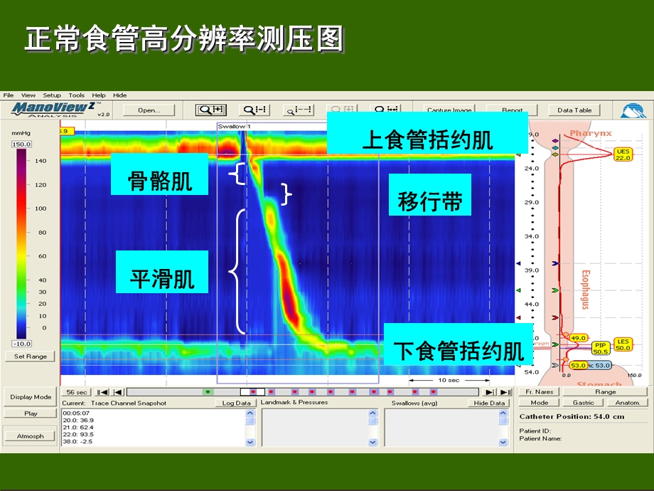 高分辨率食管测压检测技术临床应用文档资料.ppt_第3页