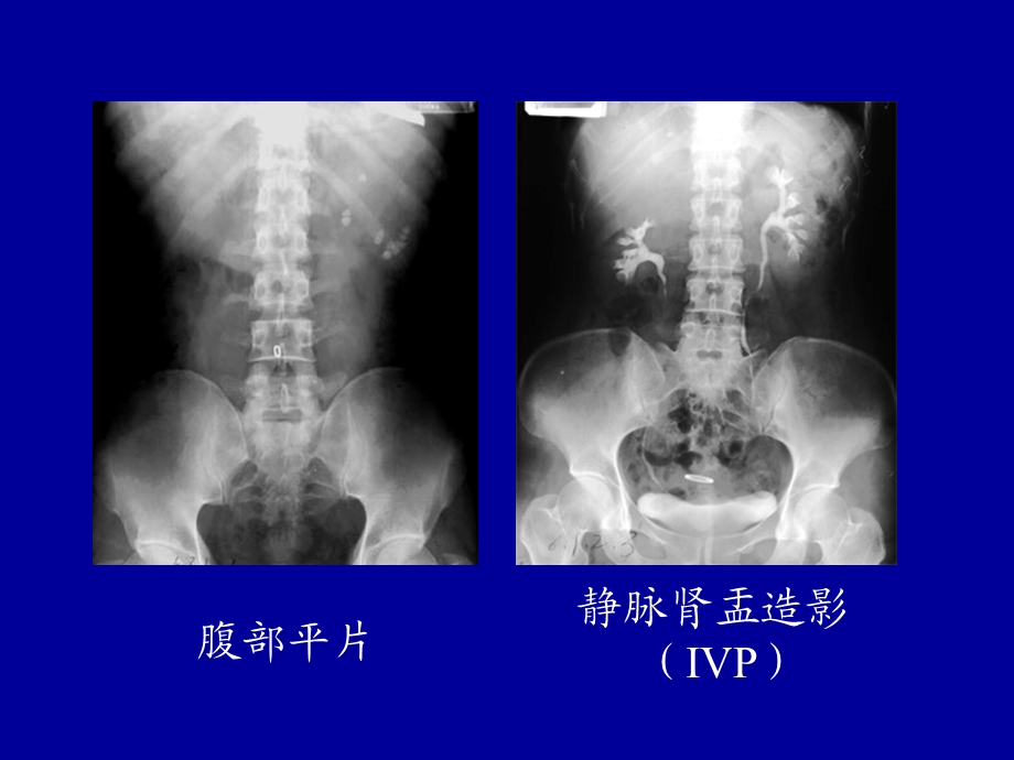 最新【医药健康】医学影像学 — 泌尿系统PPT文档.ppt_第2页