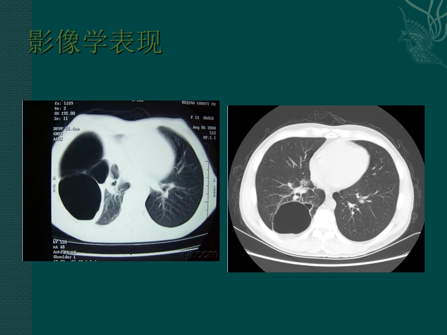 肺部囊性病变ppt课件精选文档.ppt_第3页