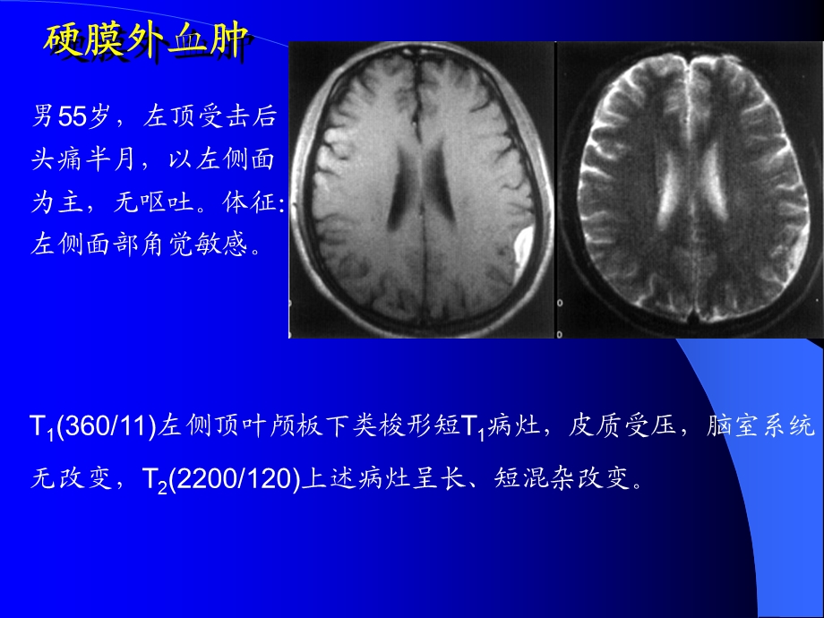 MRI图像脑01名师编辑PPT课件.ppt_第3页