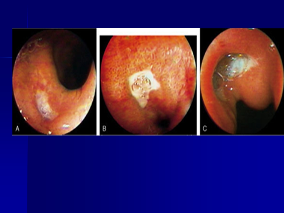 消化性溃疡20名师编辑PPT课件.ppt_第3页