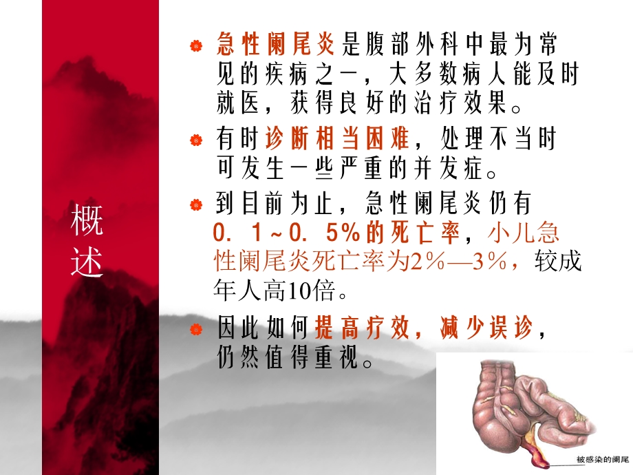 急性阑尾炎名师编辑PPT课件.ppt_第2页