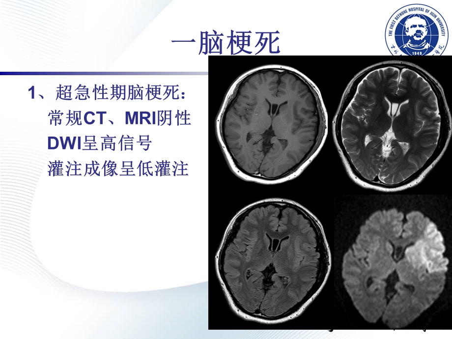 影像学神经脑血管病文档资料.ppt_第3页