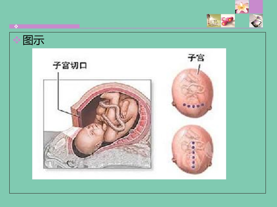 剖宫产切口愈合不良的护理文档资料.ppt_第3页