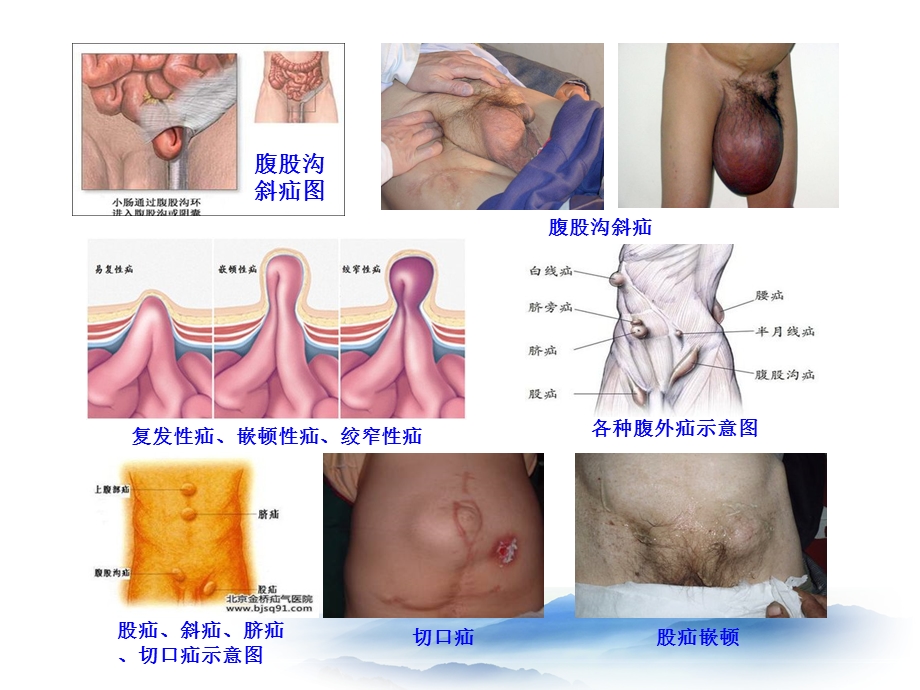 普外科常见病知识文档资料.ppt_第3页