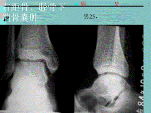 医学影像骨肿瘤X线病例图谱文档资料.ppt