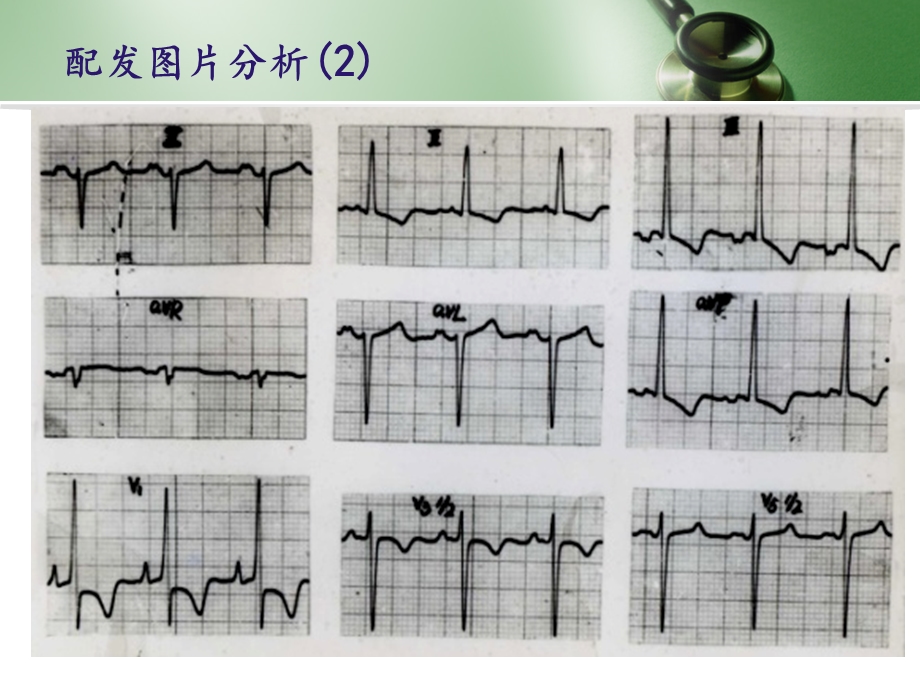 实用心电图解析ppt课件文档资料.ppt_第3页