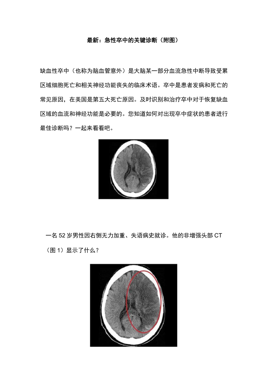 最新：急性卒中的关键诊断（附图）.docx_第1页