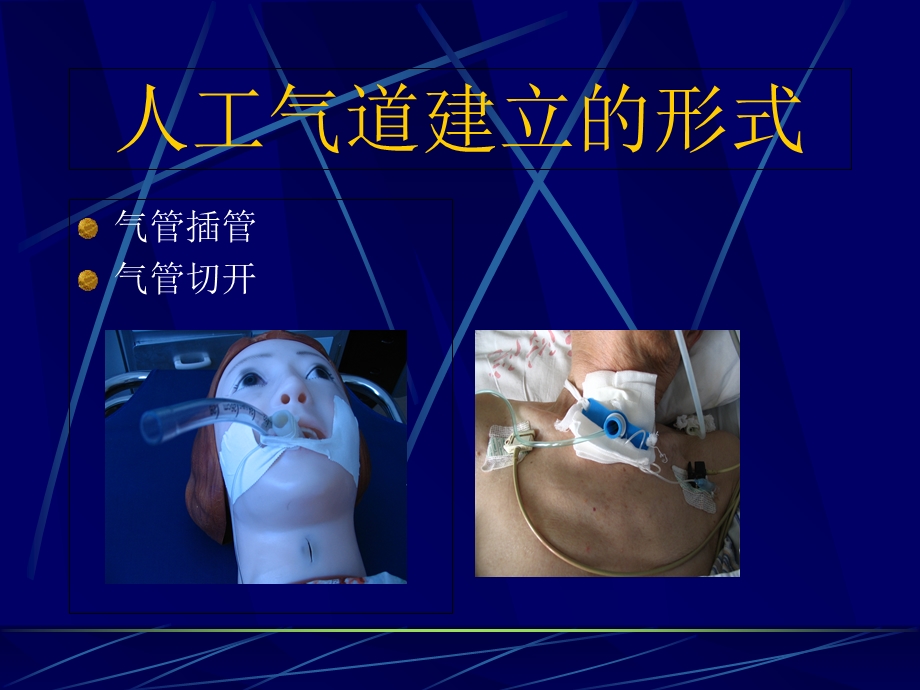 人工气道的护理精选文档.ppt_第3页