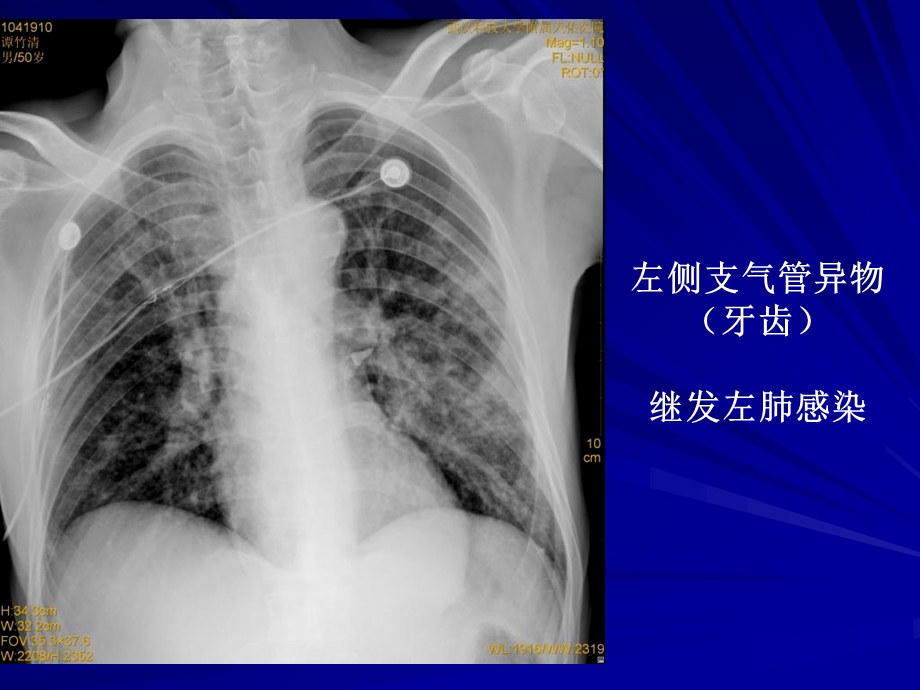 呼吸系统常见疾病影像诊断精选文档.ppt_第2页