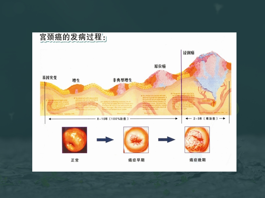 宫颈癌前病变处理方式精选文档.ppt_第2页