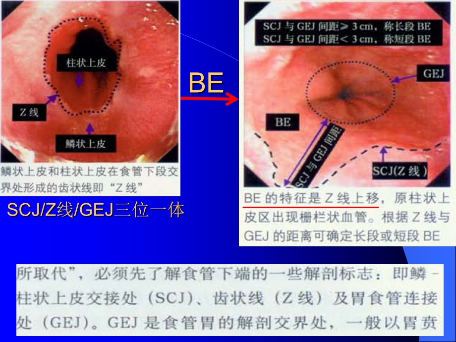 最新Barrett食管最新机制及治疗课件PPT文档文档资料.ppt_第3页