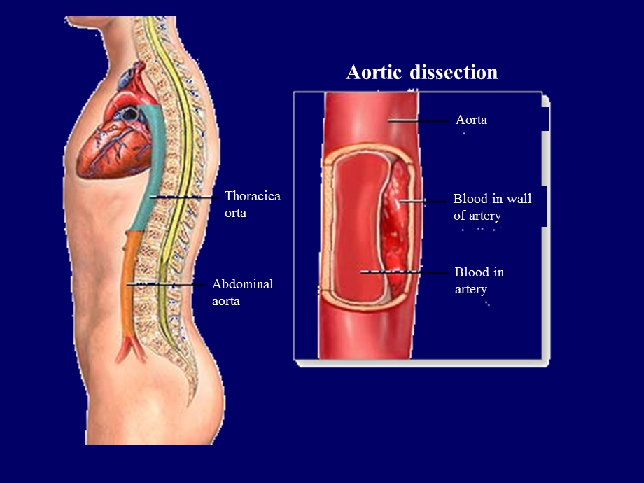 主动脉夹层的诊断与治疗PPT文档.ppt_第3页