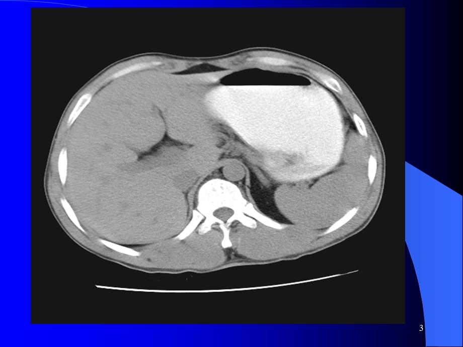 影像图谱系列腹部CT经典课件精选文档.ppt_第3页