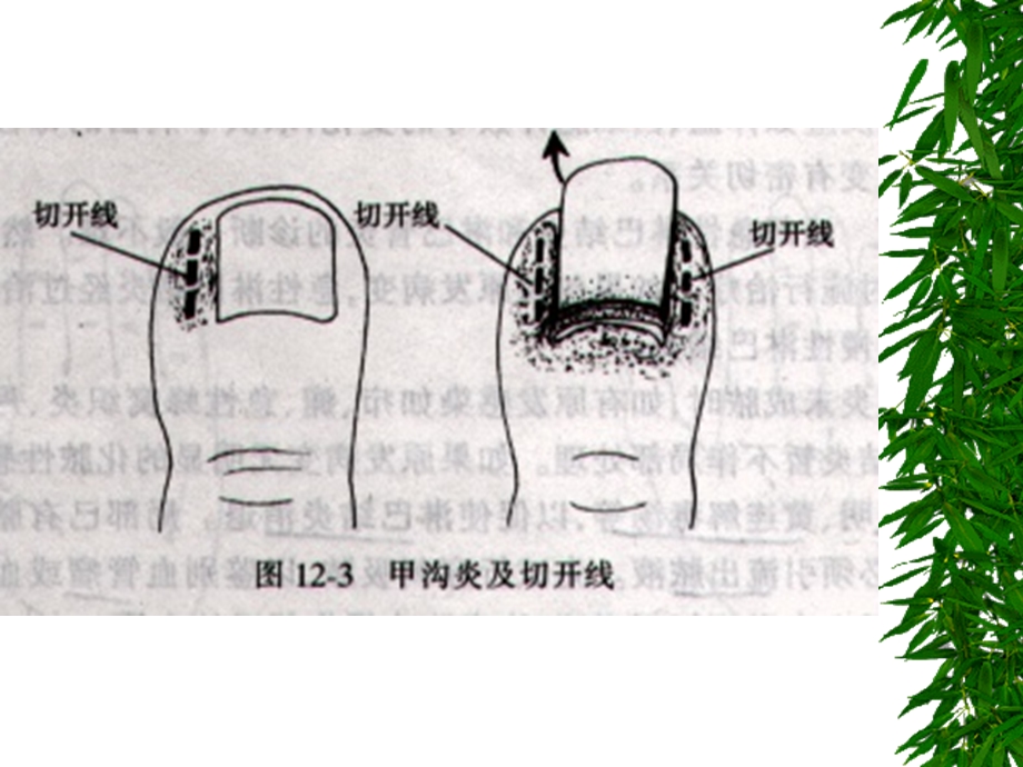 手部急性化脓性感染名师编辑PPT课件.ppt_第2页