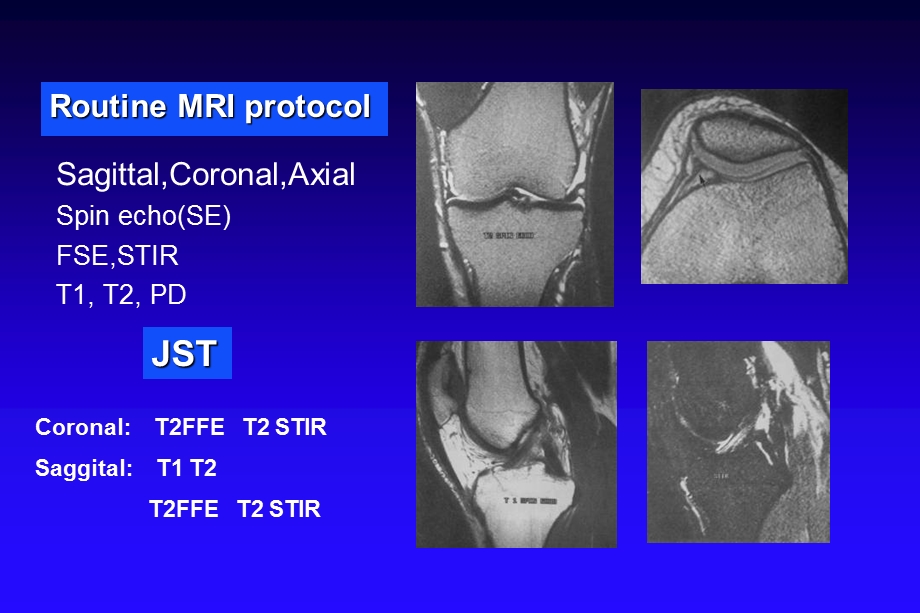 积水潭膝关节MRI名师编辑PPT课件.ppt_第2页