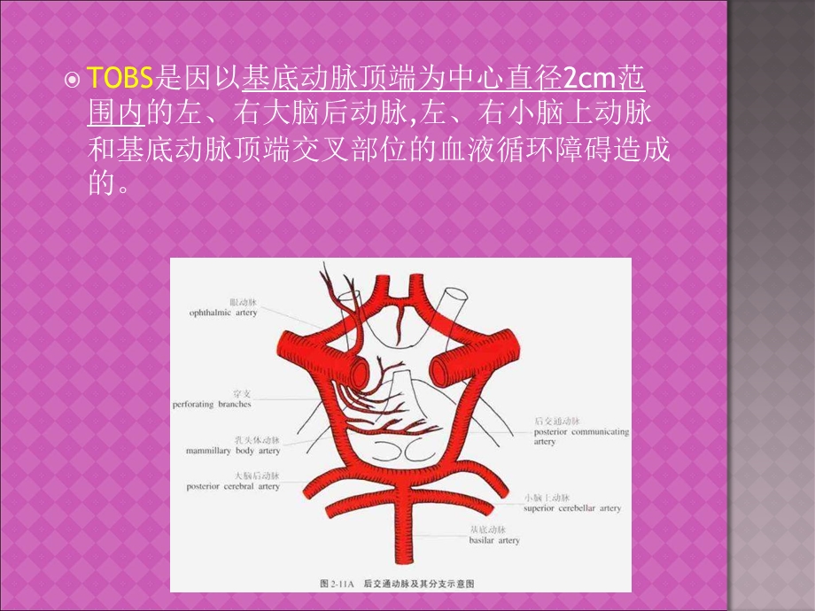 基底动脉尖综合征PPT文档.ppt_第2页