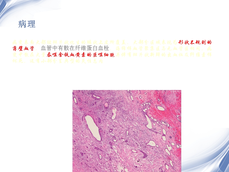 医学影像出血坏死性鼻息肉PPT文档.ppt_第3页