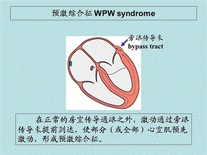 心电图课件预激综合症2lxhPPT文档.ppt