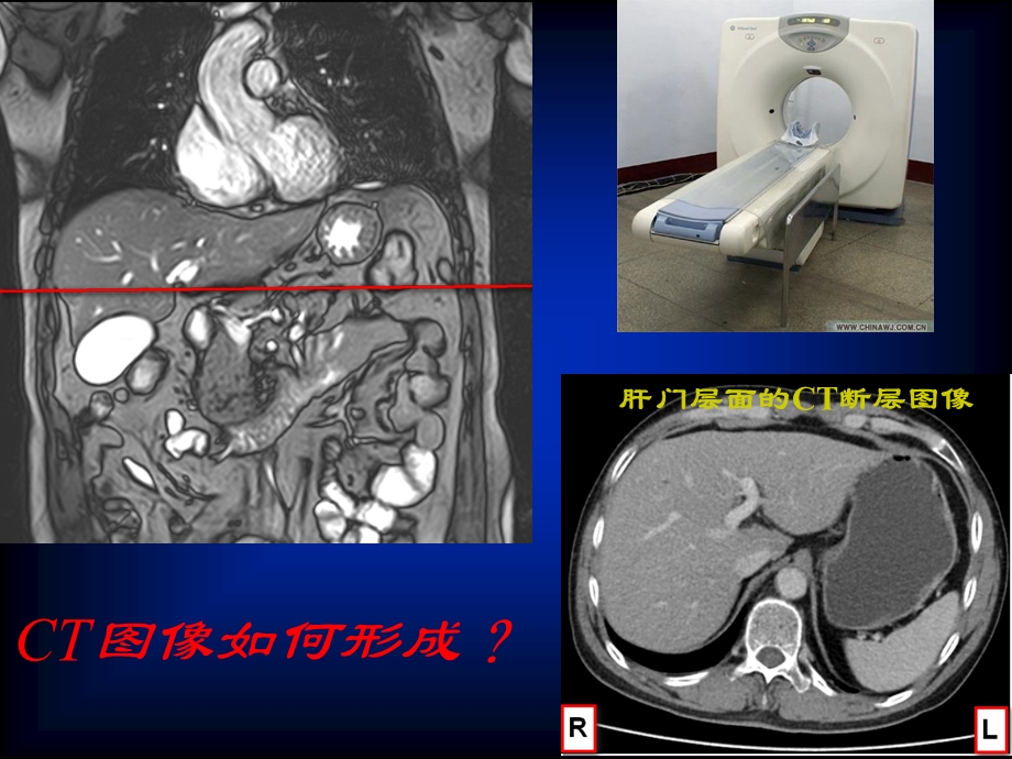 原发性肝细胞癌ct诊断与鉴别诊断ppt课件文档资料.ppt_第2页