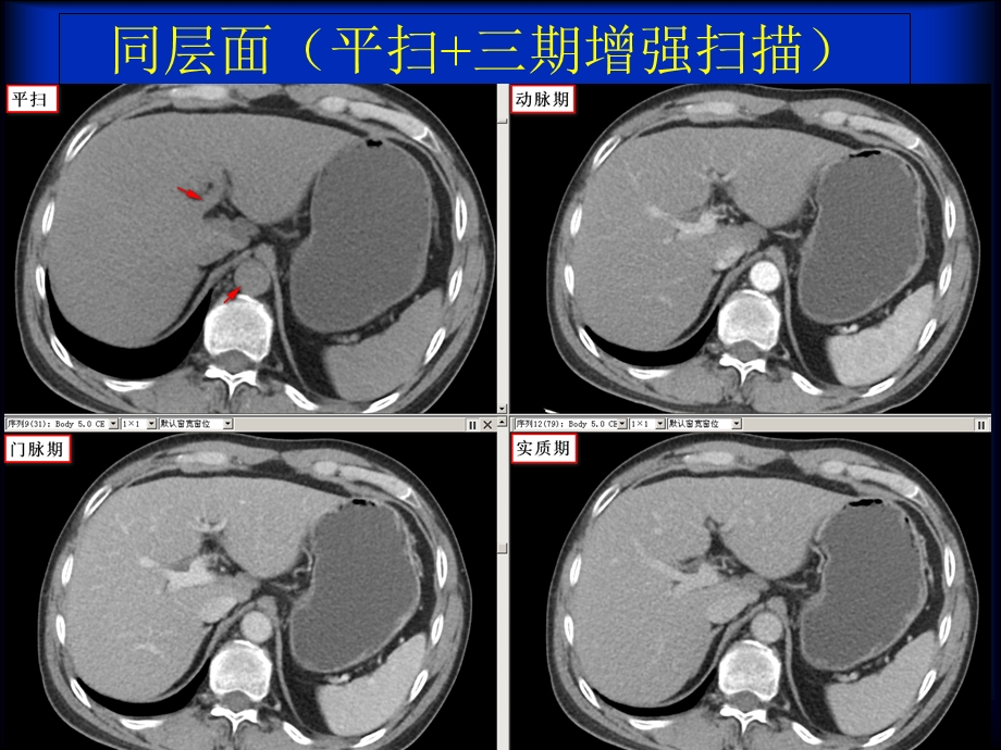 原发性肝细胞癌ct诊断与鉴别诊断ppt课件文档资料.ppt_第3页