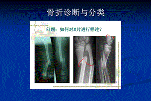 上肢骨折传统治疗技巧讲座精选文档.ppt