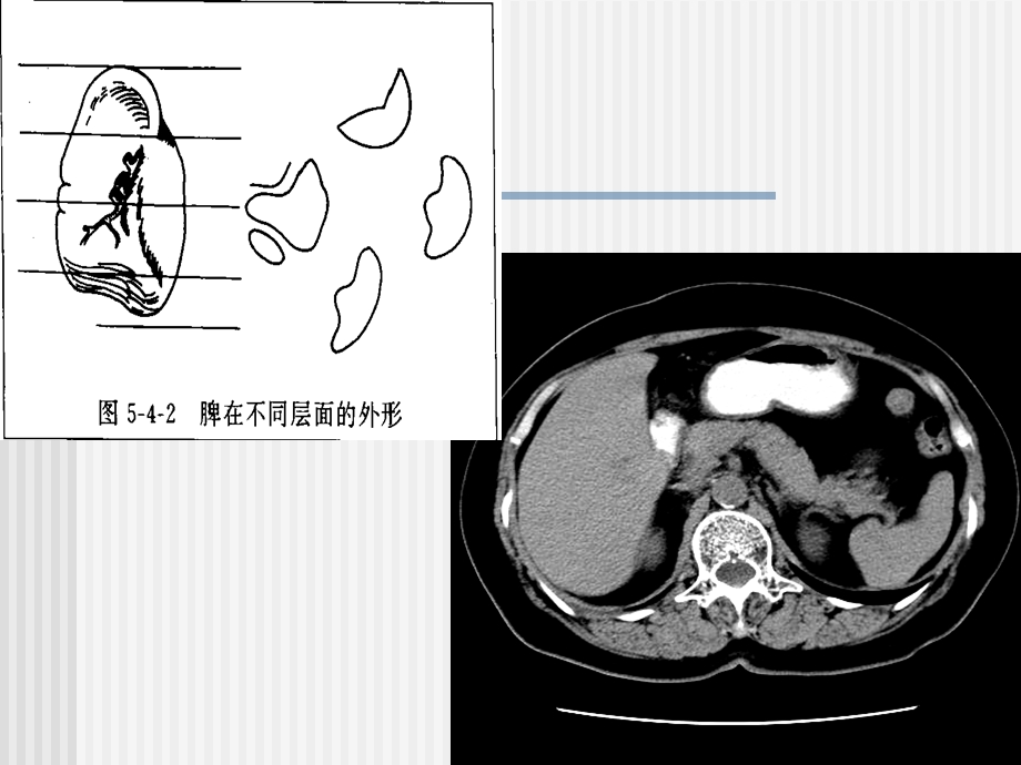 CT脾脏及其疾病PPT文档.ppt_第3页