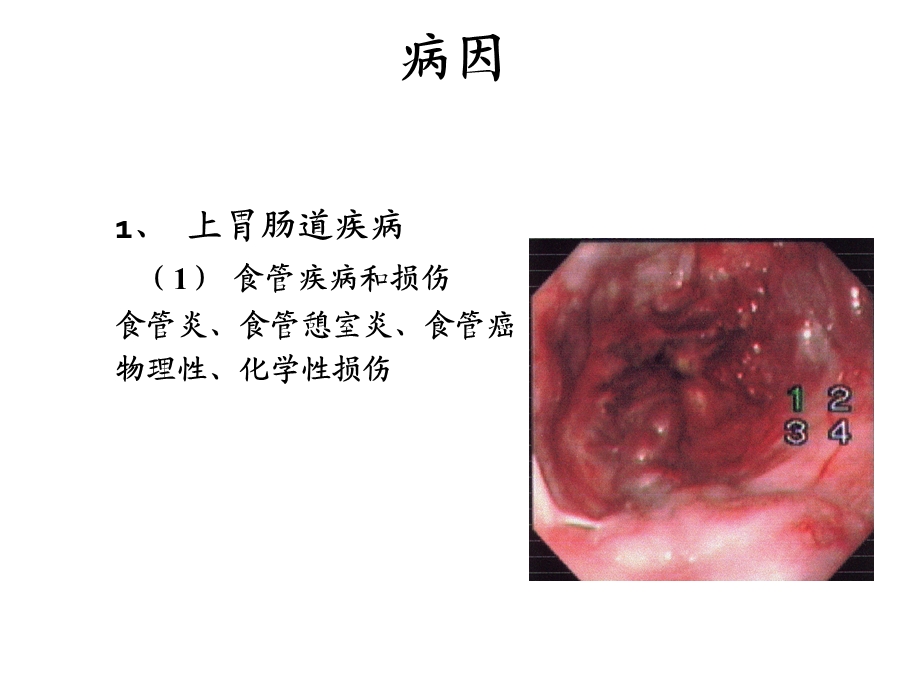 最新：上消化道出血病因、发病机制、影响因素文档资料.pptx_第2页