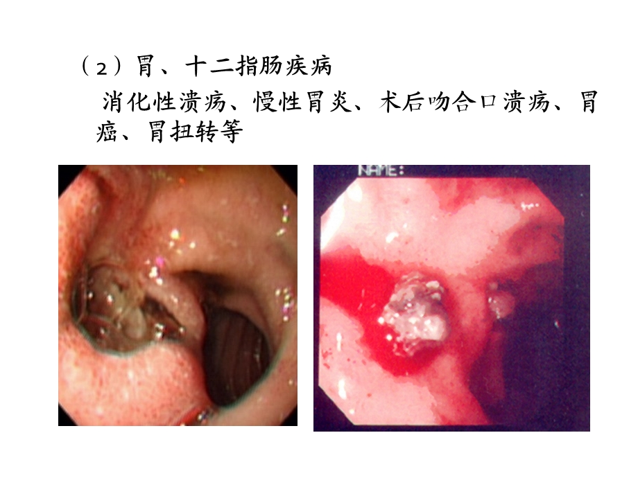 最新：上消化道出血病因、发病机制、影响因素文档资料.pptx_第3页