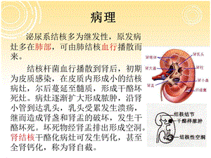 最新：肾与输尿管结核的影像诊断ppt课件文档资料.ppt