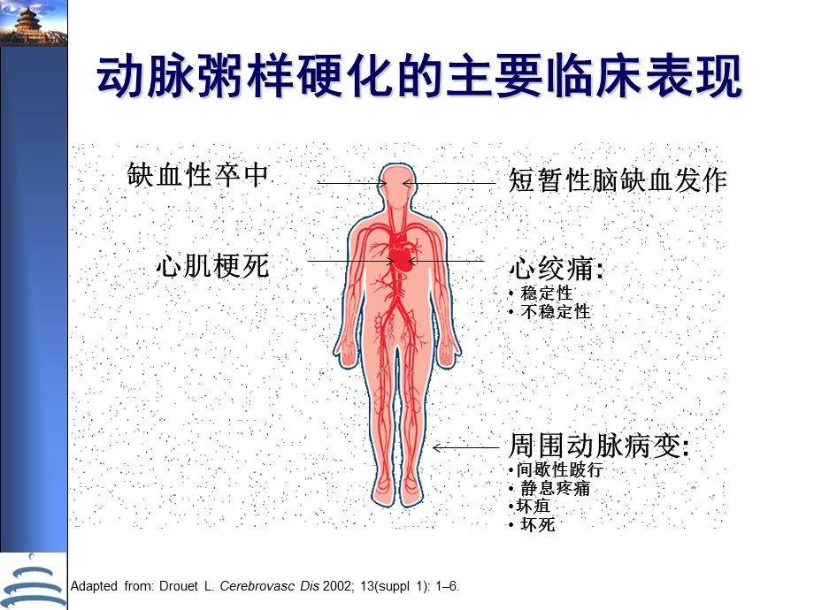 [PPT模板]脑动脉粥样硬化.ppt_第2页