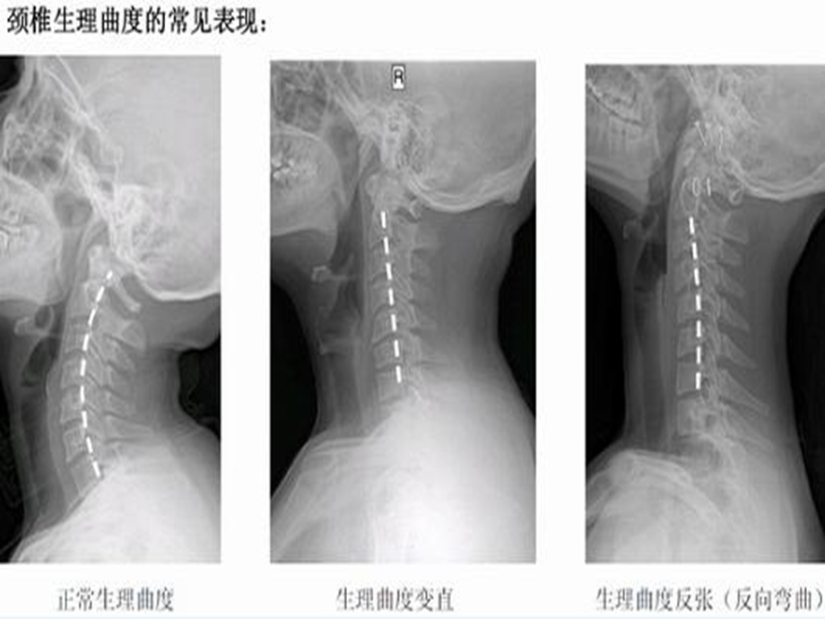 如何远离颈椎病精选文档.ppt_第3页