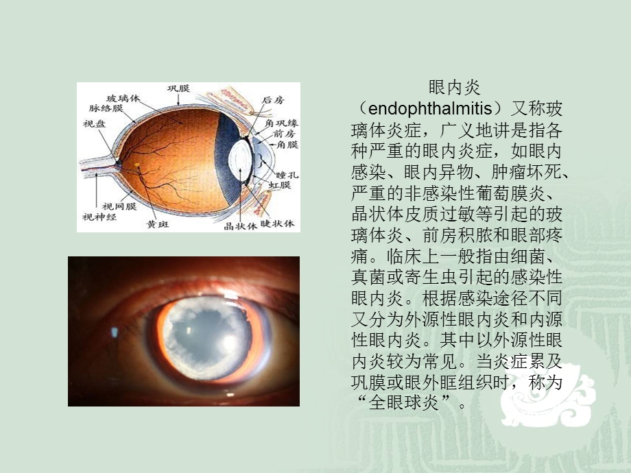 最新：眼内炎患者的疾病文档资料.ppt_第1页