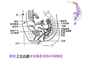 子宫内膜异性疾病课件PPT课件.ppt