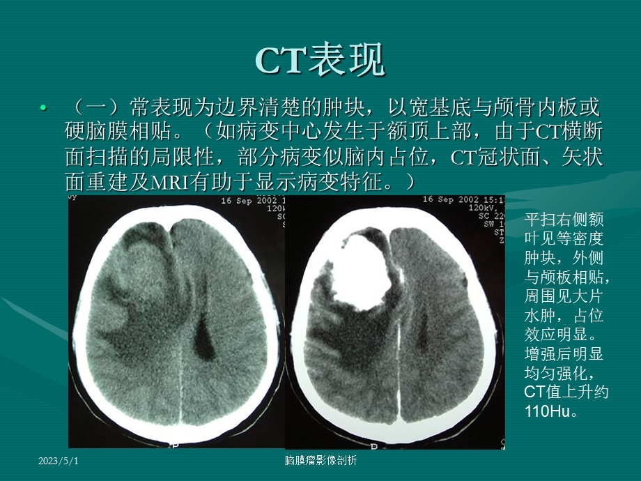 最新：脑膜瘤CT、MRI表现文档资料.ppt_第2页