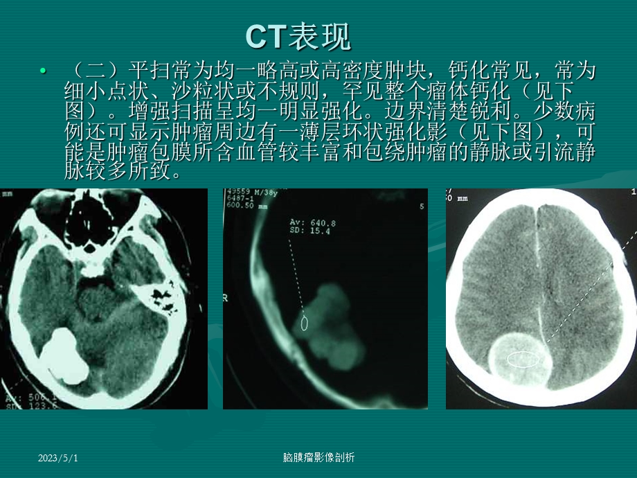 最新：脑膜瘤CT、MRI表现文档资料.ppt_第3页