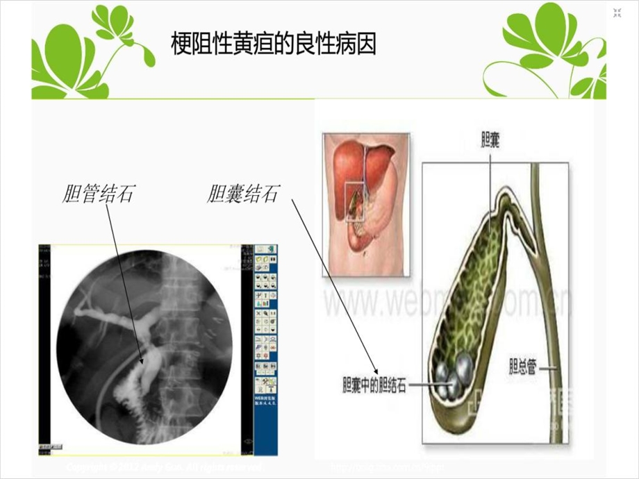 梗阻性黄疸护理查房文档资料.ppt_第3页