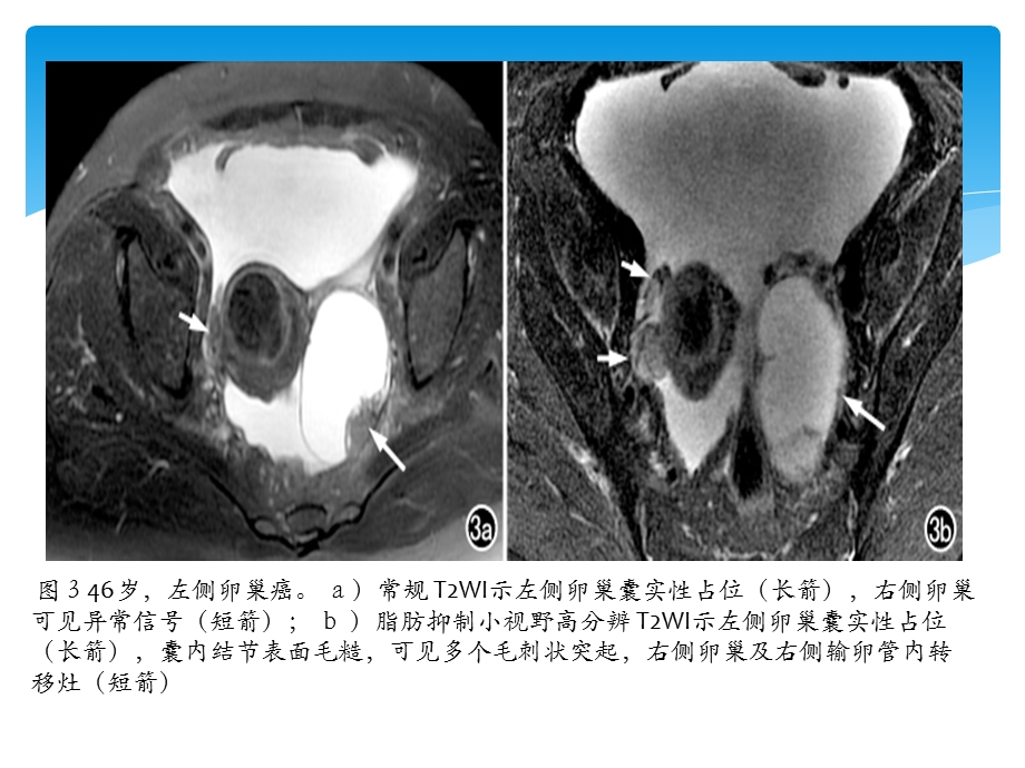 小视野高分辨及dcemri结合在女性生殖系统肿瘤中的应用PPT文档.pptx_第3页