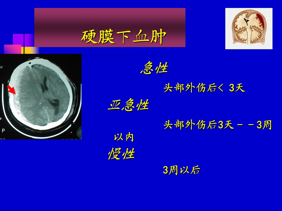 急性硬膜下血肿PPT文档.ppt_第2页