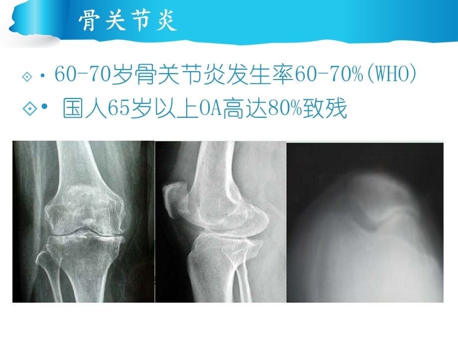 oa关节镜治疗赵世永文档资料.pptx_第1页