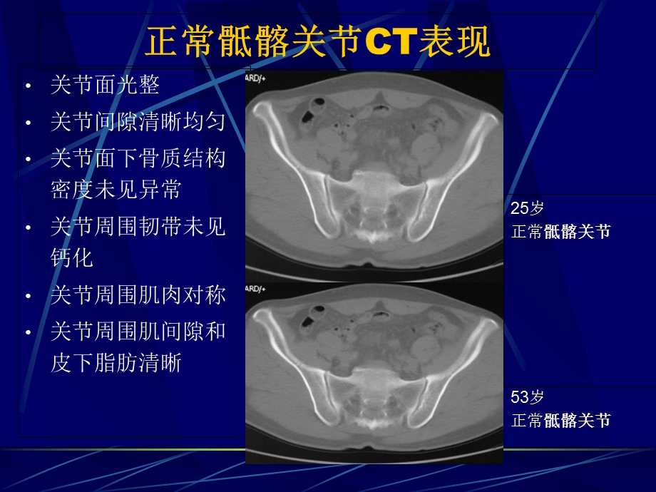 AS骶髂关节病变的CT诊断文档资料.ppt_第2页