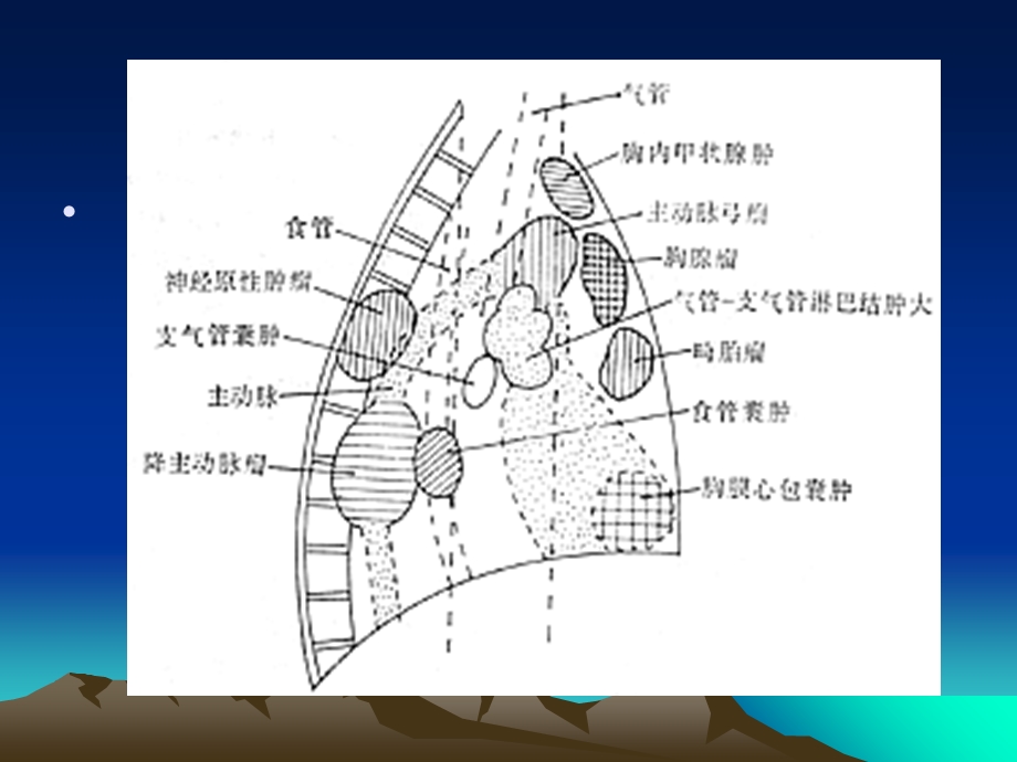 纵隔肿瘤影像诊断文档资料.ppt_第3页