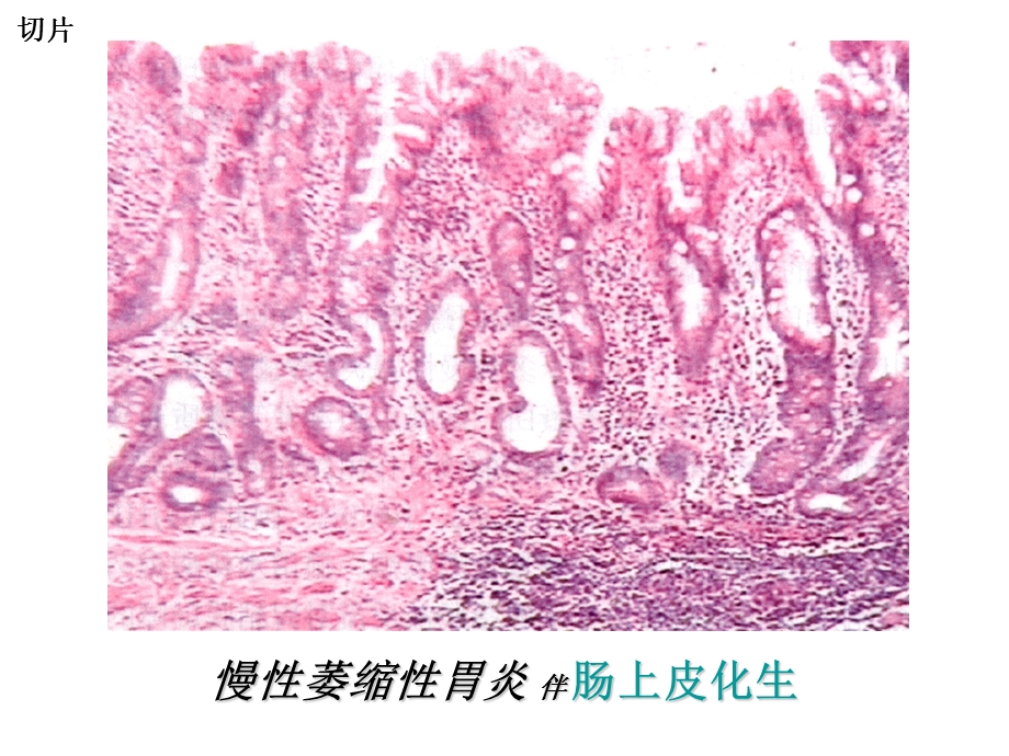 [临床医学]泸州医学院病理考试切片.ppt_第3页