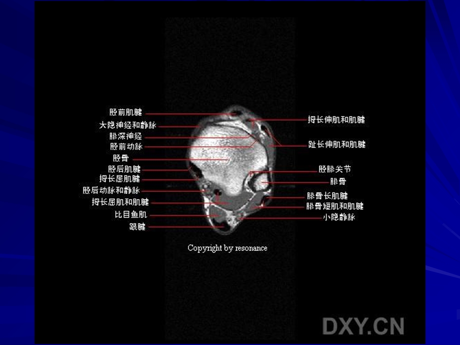 最新正常踝关节mr解剖PPT文档.ppt_第2页