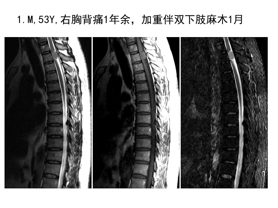 最新椎管髓外占位性病变影像诊断ppt课件PPT文档.ppt_第1页