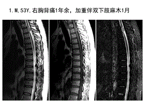 最新椎管髓外占位性病变影像诊断ppt课件PPT文档.ppt