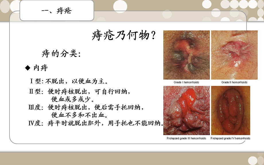 浅谈痔疮的预防文档资料.ppt_第3页