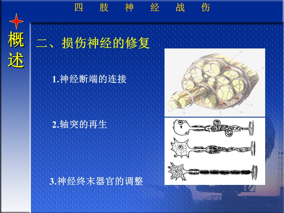 四肢神经战伤文档资料.ppt_第3页